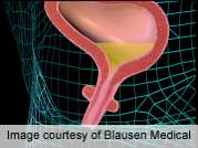 Sling offers lasting benefit for stress urinary incontinence