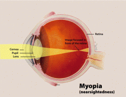 Specialty contact lenses may one day help halt the progression of nearsightedness in children
