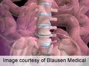 Spinal fusion surgery not associated with stroke