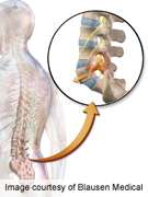 Spondylolisthesis linked to spinous process fractures
