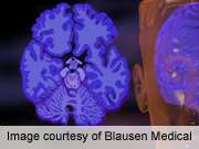 Supplement mixture improves memory in mild alzheimer's