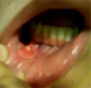 Taking multivitamins won't prevent canker sores, study says