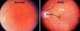 The genetic basis for age-related macular degeneration