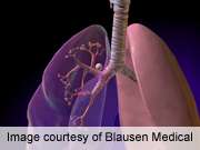 Tissue platinum concentrations linked to response in NSCLC