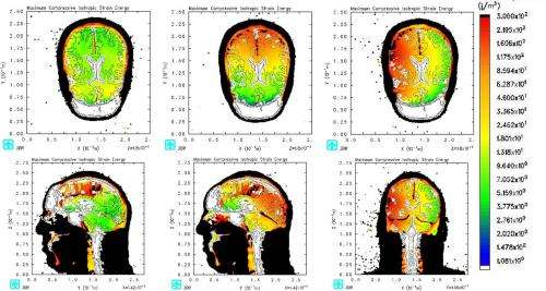 Traumatic brain injury patients, supercomputer simulations studied to improve helmets