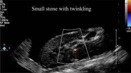 Twinkle, twinkle kidney stone: With a push you could be gone