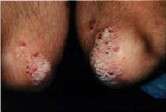 UVB preferred for treatment of moderate to severe psoriasis
