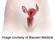 Vaginal dilation outcomes equivalent to vaginoplasty