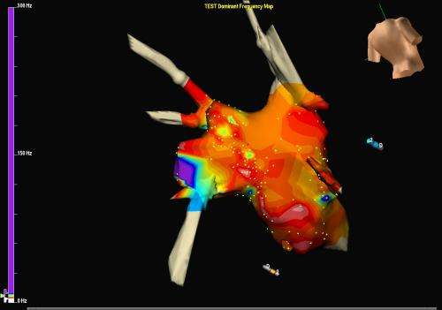 High frequency source ablation effective in treating atrial fibrillation