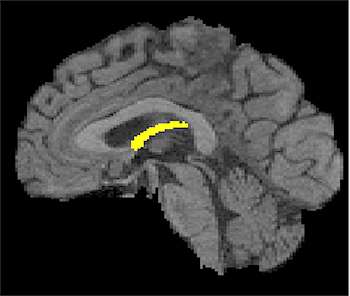 Brain circuitry loss may be a very early sign of cognitive decline in healthy elderly people