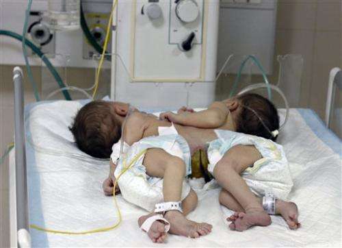 Conjoined twins with shared heart can't be split