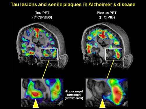 Fluorescent compounds allow clinicians to visualize Alzheimer's disease as it progresses