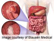 Intervention to improve colon cancer screening ineffective
