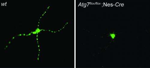 Key cellular auto-cleaning mechanism mediates the formation of plaques in Alzheimer's brain