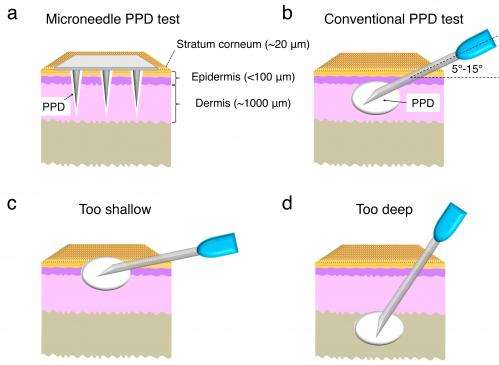 Microneedle patch could replace standard tuberculosis skin test