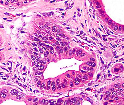 Pluripotent cells from pancreatic cancer cells first human model of cancer's progression