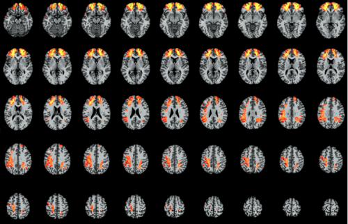 Researchers map brain areas vital to understanding language