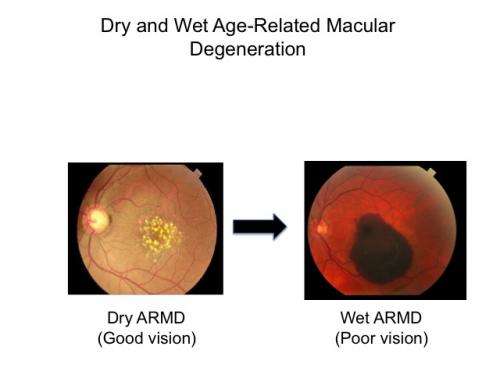 Research points to promising treatment for macular degeneration