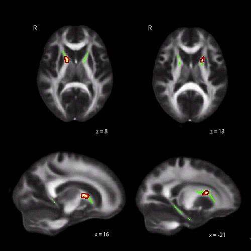Study finds neural differences in good navigators