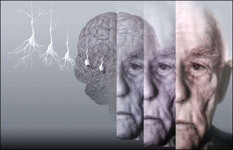 Researchers investigate mechanism of Alzheimer's therapy