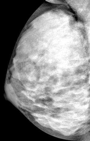 Breast cancer risk related to changes in breast density as women age