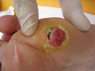 Researchers explain why some wound infections become chronic
