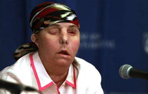 US woman disfigured in lye attack reveals new face