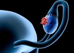 Discovery opens doors to new ovarian cancer treatments