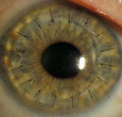 NIH-funded study finds donor age not a factor in most corneal transplants