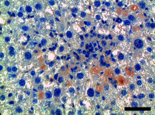 Study reveals much-needed strategy to protect against deadly liver fibrosis
