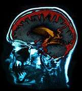 Researchers test implanted brain stimulator for alzheimer's