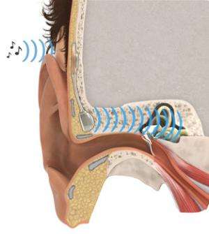 New implant replaces impaired middle ear