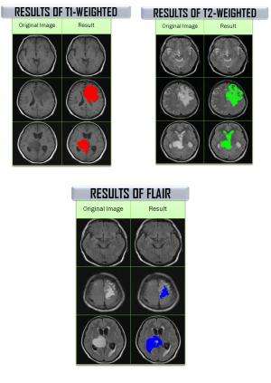 Research Highlight - Spectral Texture Segmentation of Magnetic Resonance Imaging (MRI) Brain Images For Glioma Brain Tumour Dete