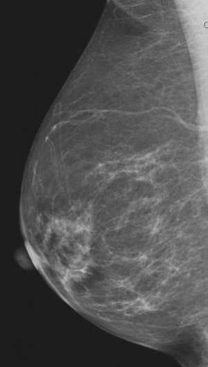 Breast cancer risk related to changes in breast density as women age