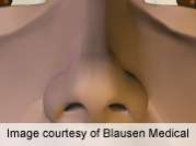Ablative carbon dioxide laser effective for rhinophyma