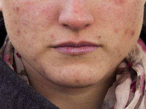 Acne treatment: Natural substance-based formula is more effective than artificial compounds