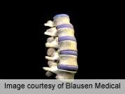 Alendronate reduces adjacent-level vertebral fractures