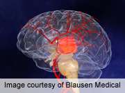 一项新的研究显示，抗血小板药物不会增加脑出血的风险