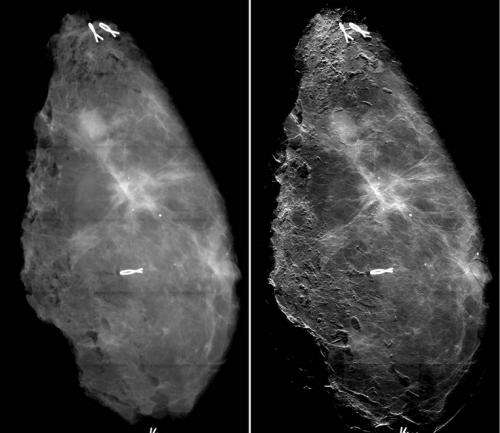 A promising new method for the diagnosis of breast cancer