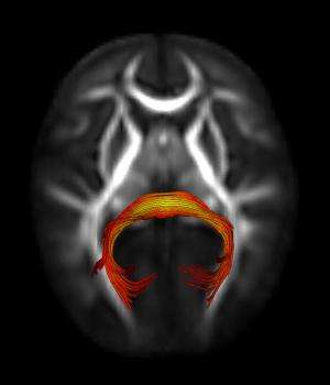 Atypical brain circuits may cause slower gaze shifting in infants who later develop autism