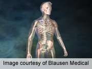 Bone density can improve in spine, femur post-spine surgery