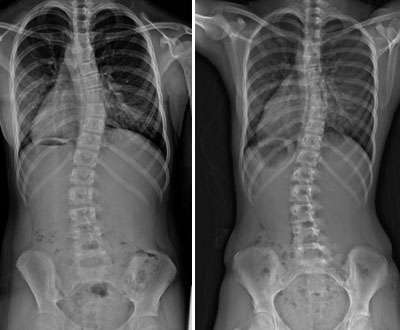 Bracing is effective in adolescents with idiopathic scoliosis
