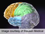 Brain atrophy seen in patients with diabetes