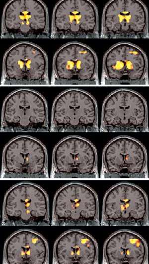 Brain imaging shows how prolonged treatment of a behavioral disorder restores a normal response to rewards