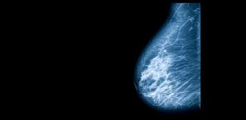 Breast conserving treatment with radiotherapy reduces risk of local recurrence