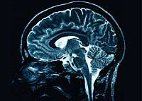 Children's brain processing speed indicates risk of psychosis