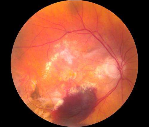 Cholesterol-lowering eye drops could treat macular degeneration