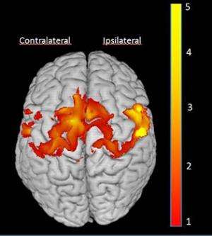 CI Therapy produces increase in grey matter in brains of children with cerebral palsy