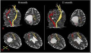 Clinicians should pay attention to stroke patients who cannot walk at 3-6 mon after onset