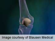 Coexisting pain tied to worse knee replacement outcomes